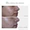 Novology Acne Spot Corrector Fights Active Acne, Whiteheads, Pimples For Acne Prone Skin (30 g)
