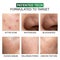 Novology Acne Clearing Cleanser for Acne Whiteheads and Blackheads for Sensitive Skin (100 g)